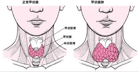 甲亢症，很多人正在被这个病折磨，邓老这个方子帮你摆脱痛苦！