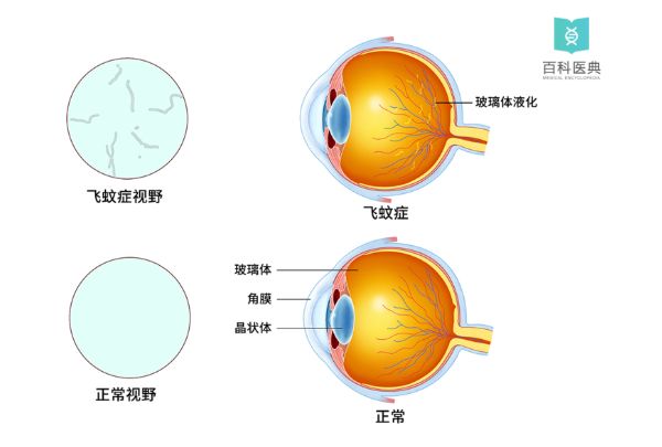 赤脚：谈谈“飞蛾症”的调理思路和方法