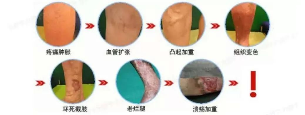 静脉曲张、老寒腿，中医怎么调？