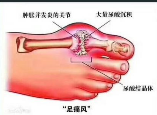 让人闻风丧胆的痛风，中医用这3个中成药搞定。