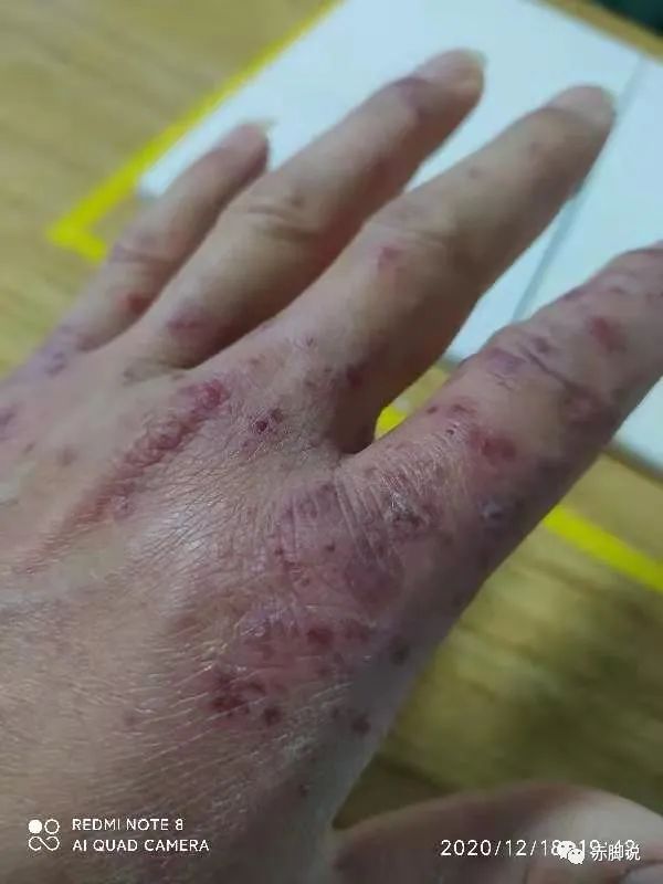 聊聊冻疮的内调外治，这6个方法总有一个适合你。