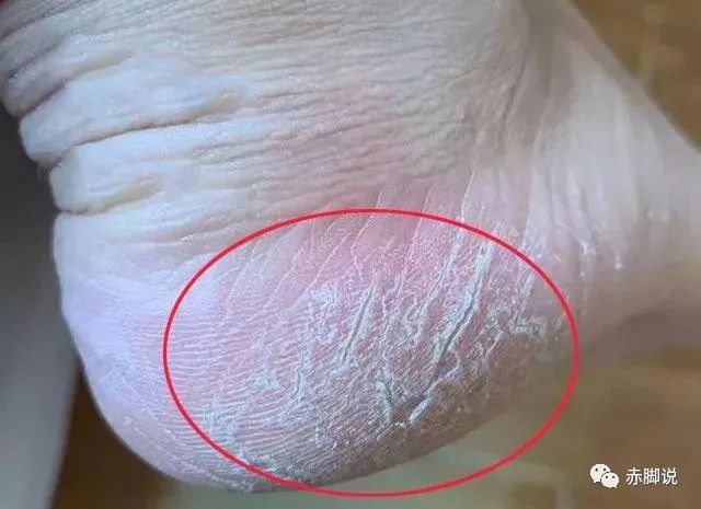 脚后跟开裂好难受，国医大师留下的这个验方治好过很多人，试试？
