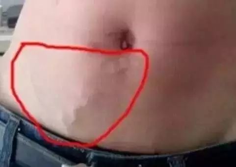 腹部青筋