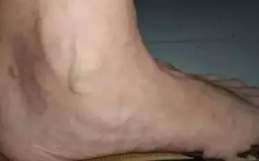 下肢青筋:关节炎