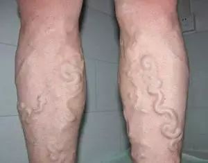 小腿青筋