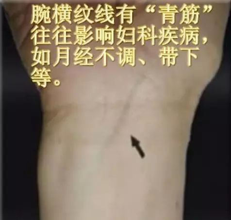 腕部横纹线有青筋