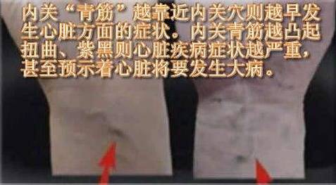 内关青筋
