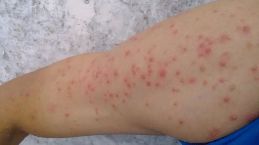 春季常见病,湿疹瘙痒